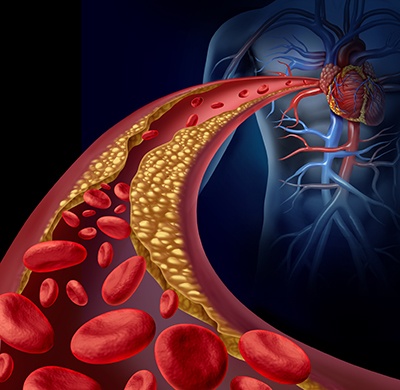 PCSK9-inhibitor-data.jpg