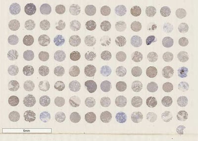 example pre-made FFPE tumor microarray (TMA) slide showing Ki-67 staining of colorectal cancer cores