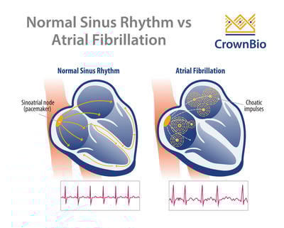 diagram displaying normal heart rhythm and heartbeat trace versus atrial fibrillation and abnormal heartbeat