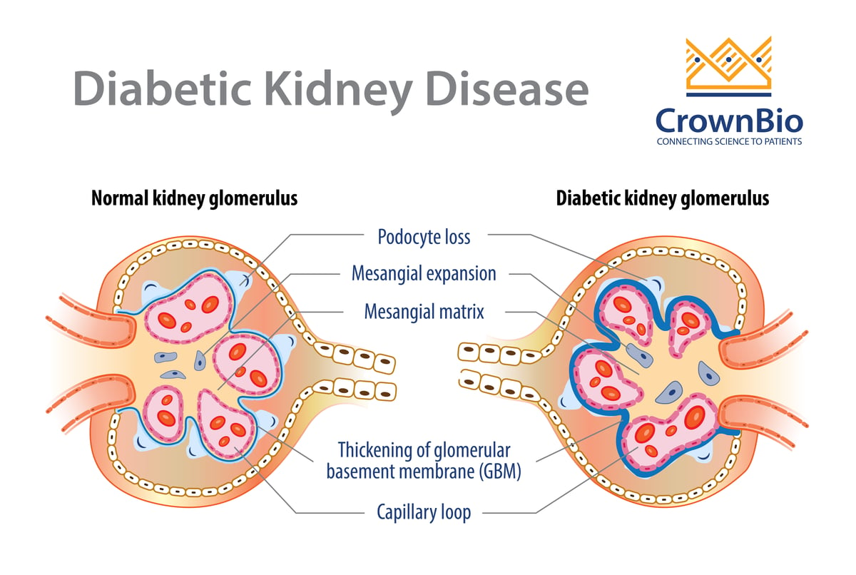 Renal Disease Diabetes Chronic Renal Disease Pathophysiology Causes 