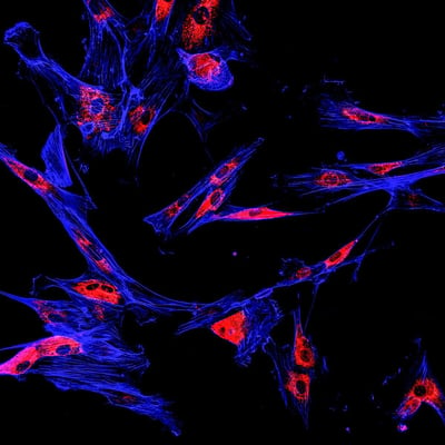 melanoma, immunofluorescence imaging, disease progression and metastasis