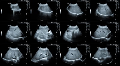 noninvasive liver disease diagnosis, nash nafld fatty liver preclinical testing through non-invasive echography