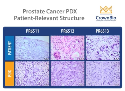 immunohistochemistry images showing that prostate cancer pdx models retain the structure of original patient tumors