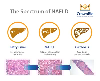 fatty liver progression, NAFLD progression to NASH, NASH diagnosis techniques, noninasive NASH diagnosis