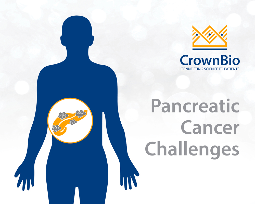 graphic of pancreatic cancer tumors