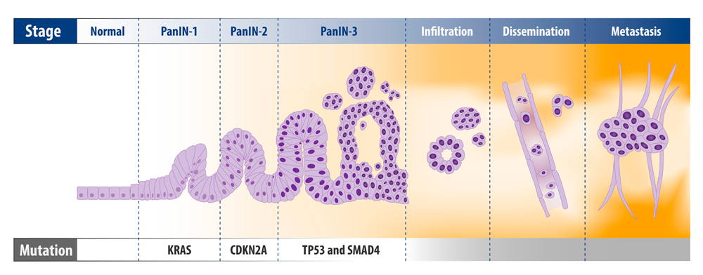 Pancreatic Cancer Progression